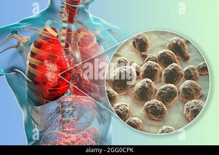 Illustrazione di una criptoccosi polmonare, invasione di un tessuto polmonare da parte di funghi di lievito Cryptococcus neoformans con vista ravvicinata dei funghi. Foto Stock