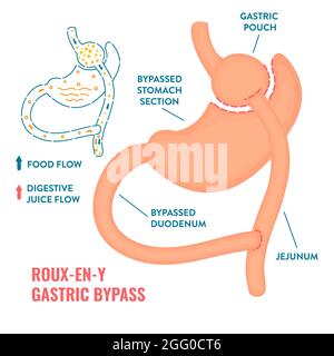 Roux-en-Y bypass gastrico chirurgia bariatrica, illustrazione. Foto Stock