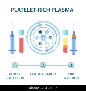 Procedura del plasma ricco di piastrine (PRP), illustrazione. Foto Stock