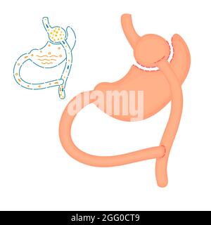 Roux-en-Y bypass gastrico chirurgia bariatrica, illustrazione. Foto Stock