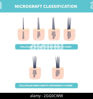 Set di classificazione per microtrapianto di capelli per chirurgia di trapianto di capelli, illustrazione concettuale. Foto Stock