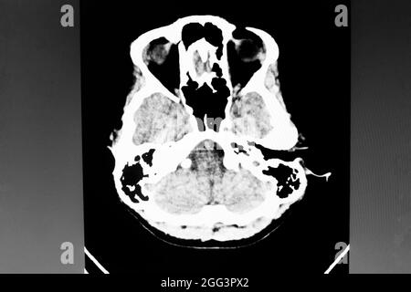 Immagine della tomografia computerizzata del cervello Foto Stock