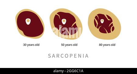 Sarcopenia negli anziani. Sostituzione del tessuto muscolare con grasso nel processo di invecchiamento. Illustrazione vettoriale Illustrazione Vettoriale