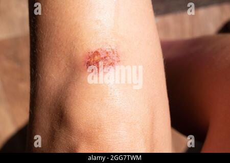 Una ferita sul ginocchio di una donna dopo un colpo, una caduta. Trattamento traumatologico e cura. Foto Stock