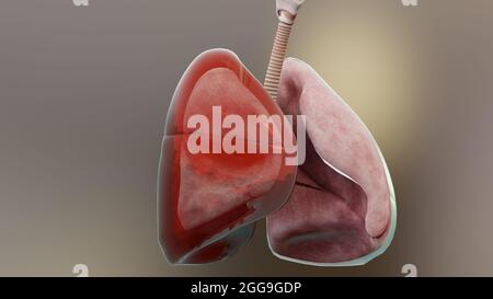 Illustrazione 3d di Emothorax, polmone normale versus collassato, sintomi di Emothorax, versamento pleurico, empyema, complicazioni dopo una lesione toracica, Foto Stock