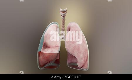 Illustrazione 3d di Hemopneumotorax, polmone normale contro collassato, sintomi di Hemopneumotorax, versamento pleurico, empyema, complicazioni Foto Stock