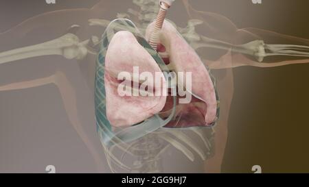 Illustrazione 3d di pneumotorace, polmone normale verso collassato, sintomi di pneumotorace, versamento pleurico, empyema, complicazioni dopo una lesione toracica Foto Stock