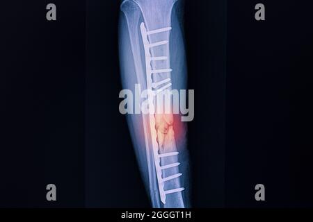 Ditta radiologica di un paziente con frattura della tibia destra dopo fissaggio chirurgico con piastre metalliche e viti. Foto Stock