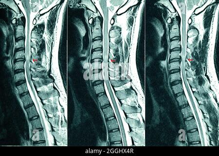 C- scansione MRI delle spine di un paziente con debolezza cronica delle estremità inferiori che mostra il nucleo erniato pulposus a livelli C4-C5. Foto Stock