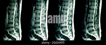 Scansione MRI delle spine lombari di un paziente con dolore cronico alla schiena che mostra un cambiamento degenerativo delle spine lombari e sacrali con essiccazione del disco. Foto Stock