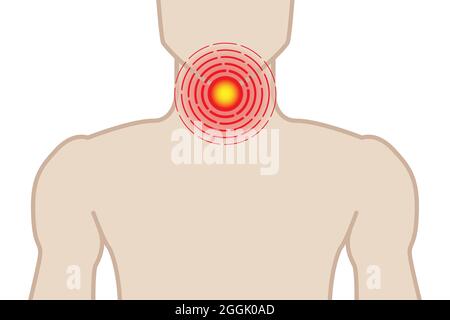 Illustrazione di Sore Throat con l'uomo su sfondo bianco Illustrazione Vettoriale