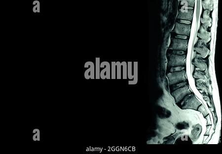 Scansione MRI delle spine lombari di un paziente con dolore cronico alla schiena che mostra un cambiamento degenerativo delle spine lombari e sacrali con essiccazione del disco e di Foto Stock