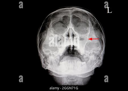 pellicola radiogena di un cranio di un paziente (seno paranasale) con sinusite mascellare acuta destra (freccia rossa) con livello del liquido dell'aria Foto Stock