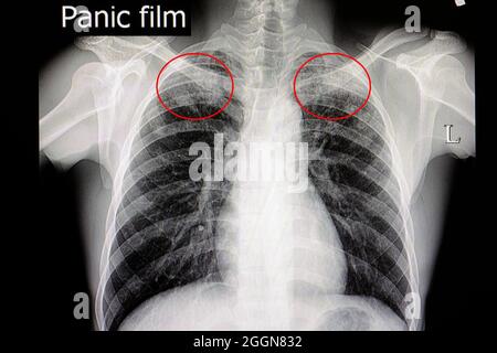 Pellicola radiogena di un pateint con tubercolosi polmonare Foto Stock