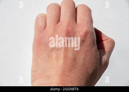 Primo piano di una mano femminile con rughe fini, pelle desquamazione, pelle secca. Concetto di assistenza sanitaria. Foto Stock