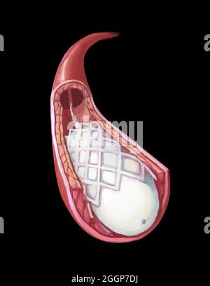 Illustrazione medica che mostra l'angioplastica con palloncino e l'inserimento dello stent. Foto Stock