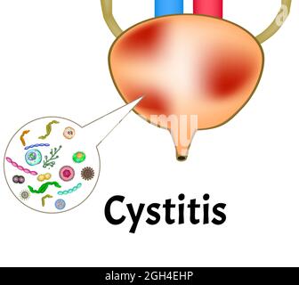 Cistite. Infiammazione della vescica. La struttura dei reni e della vescica. Sistema di escretorio. Infografiche. Illustrazione del vettore su isolato Illustrazione Vettoriale