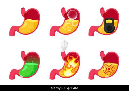 Bruciore di stomaco, gonfiore, pesantezza, avvelenamento, ulcera e sano con succo di acido gastrico. Disturbi del sistema digestivo. Illustrazione di un organo in sezione EPS vettoriale Illustrazione Vettoriale