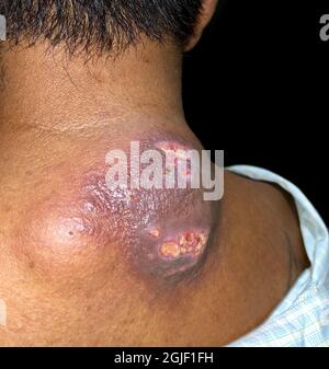 Ascesso grande con cellulite circostante o Staphylococcal, infezione della pelle Streptococcal nella parte superiore della parte posteriore del paziente maschio birmano asiatico. Vista laterale. Foto Stock