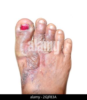 Ustione ferita circondata da cicchi e lieve cellulite ai piedi della donna sud-orientale asiatico. Isolato su bianco. Foto Stock