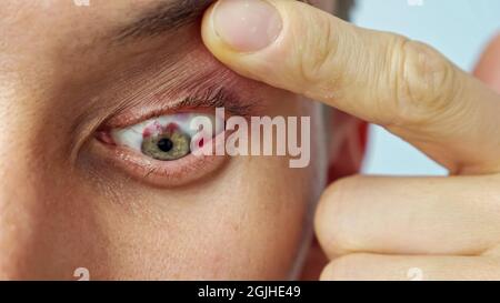 primo piano dell'occhio dolente di un uomo, spalmato con le dita Foto Stock