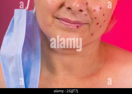 Ritratto di confronto di una donna sorridente con la pelle problematica dopo l'uso della maschera medica su pandemic, il risultato delle procedure di rimozione dell'acne. Foto Stock