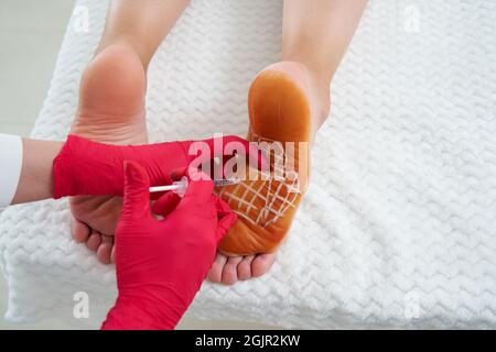 Il medico effettua iniezioni intramuscolari di tossinone botulino nei piedi femminili contro iperidrosi, sudorazione eccessiva Foto Stock