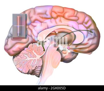 Desiderio e rottura (stato 4): Reazione del cervello un momento dopo una rottura. Foto Stock