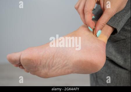 Una donna sigilla un granoturco sulla gamba con un gesso. La ragazza le sfregò la gamba con scarpe scomode. Foto Stock