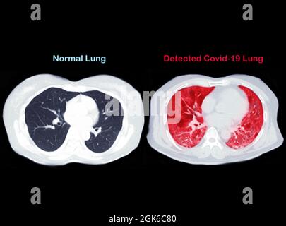 Confrontare la scansione TC della vista assiale toracica dell'infezione polmonare e polmonare normale covid-19 isolata su sfondo nero. Tracciato di ritaglio. Foto Stock