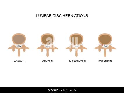 Tipi di illustrazione vettoriale dell'erniazione del disco intervertebrale lombare. Erniazione centrale, paracentrale e del disco foraminale. Illustrazione Vettoriale