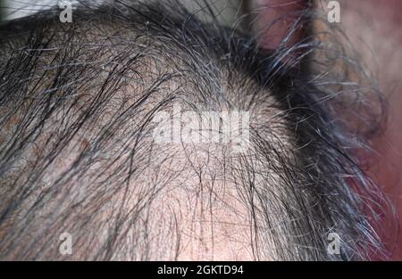 Diradamento o capelli sparsi, maschio modello perdita di capelli nel sud-est asiatico, uomo anziano cinese. Foto Stock