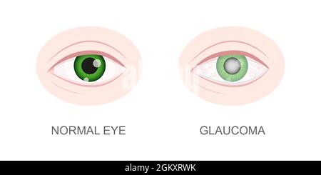 Occhio sano e con vista closeup glaucoma. Normale e nocciola, arrossamento, bulbo oculare acquoso. Organo visivo umano anatomicamente accurato. Problemi visivi di invecchiamento. Illustrazione di un cartoon vettoriale. Illustrazione Vettoriale