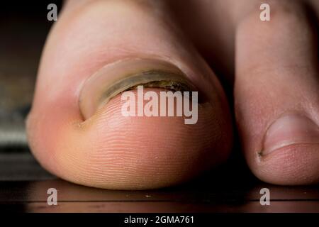 Trauma toenail del fungo dell'unghia della punta. Lesione del piede con separazione del chiodo dal letto del chiodo. Foto Stock