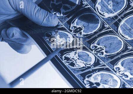 Il neurochirurgo mostra il punto di una radiografia del cervello umano con Foto Stock