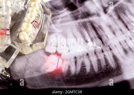 Ha influenzato i denti di saggezza su un'immagine a raggi X con un neoplasma della cisti infiammato. Rimozione dei denti di saggezza in odontoiatria Foto Stock