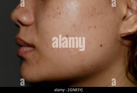 Cloasma o melasma , macchie nere e cicatrici acne sulla faccia della giovane donna asiatica. Foto Stock