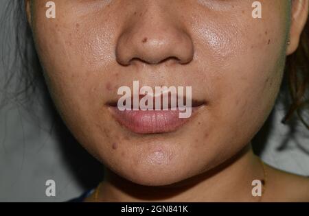 Acne , macchie nere e cicatrici sulla faccia della giovane donna asiatica. Foto Stock