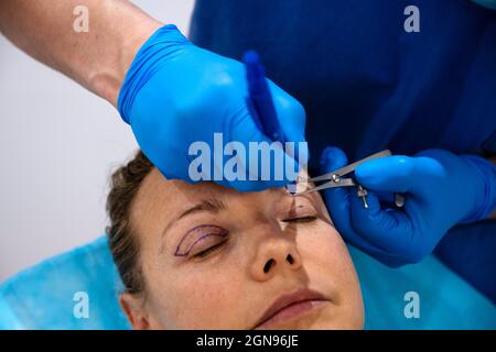 Linea tracciata dal chirurgo sull'occhio della ragazza con marcatore per la preparazione della procedura. Foto Stock