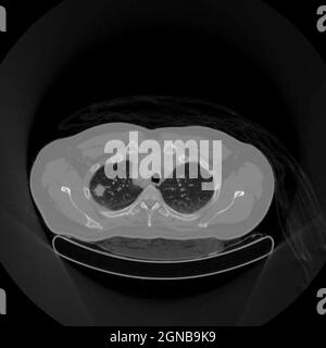 Scansione per tomografia a emissione di positroni (PET) di un paziente maschio di 54 anni. Un tumore può essere visto nel lobo superiore sinistro dei suoi polmoni Foto Stock