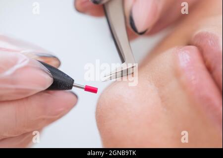 Donna con epilazione elettrica del viso. Hardware rimozione permanente dei capelli indesiderati sul mento Foto Stock