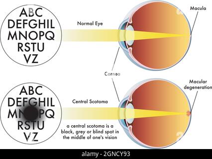 Illustrazione medica dei sintomi dello scotoma centrale. Illustrazione Vettoriale