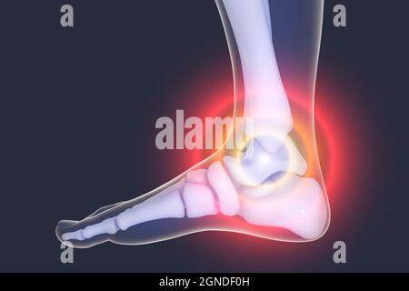 Dolore al piede, illustrazione Foto Stock