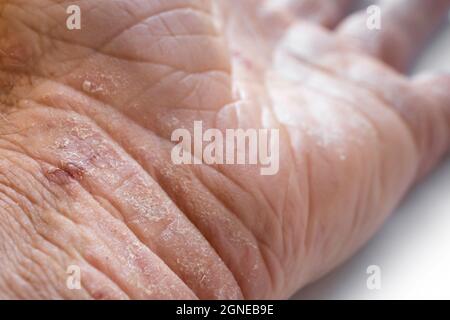 Lesioni e scab di cheratosi attinica o macchie solari sulla pelle danneggiata dal sole sul polso di un uomo. Questo può essere trattato con criochirurgia o con alcuni unguenti Foto Stock