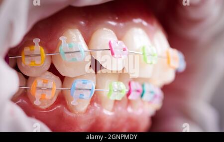 Foto macro di occlusione dentale, denti e bretelle in ceramica con fasce colorate in gomma su di essi, retrattore guancia in lattice sulle labbra. Concetto di igiene dentale Foto Stock