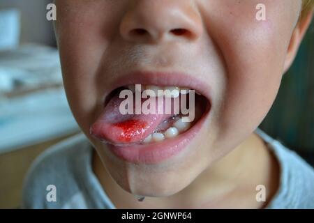 Primo piano di labbra, lingua, protrusione di sangue. Lingua morso del bambino. Foto Stock