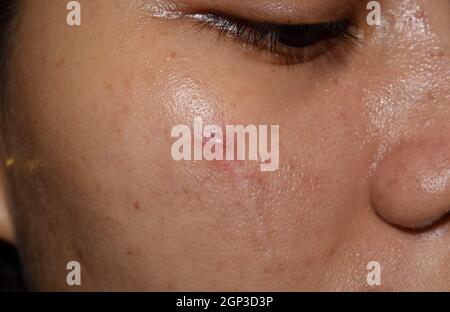 Acne , macchie nere e cicatrici sulla faccia della giovane donna asiatica. Primo piano. Foto Stock
