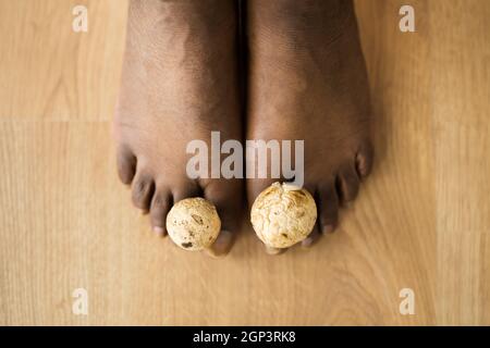 Fungo funghi tra Toenail. Piedi e funghi puzzolenti Foto Stock