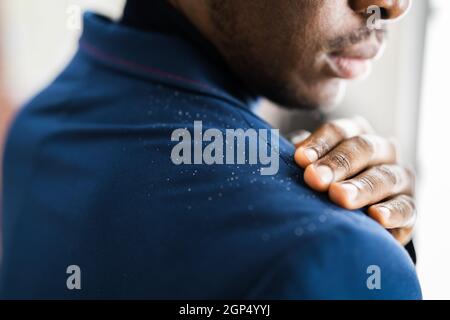 Uomo spazzolando Dandruff da vestito sporco. Prurito alla testa e ai capelli Foto Stock