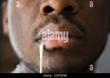 Trattamento delle labbra di Herpes Sore sul viso maschile Foto Stock